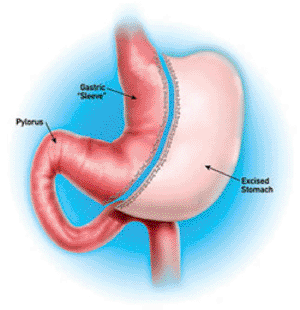 Image: Illustration of the sleeve gastrectomy surgical procedure (Photo courtesy of NYP).